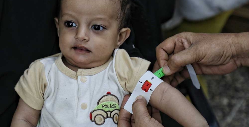 The success story of Horizon Foundation in treating child Samer from severe malnutrition.